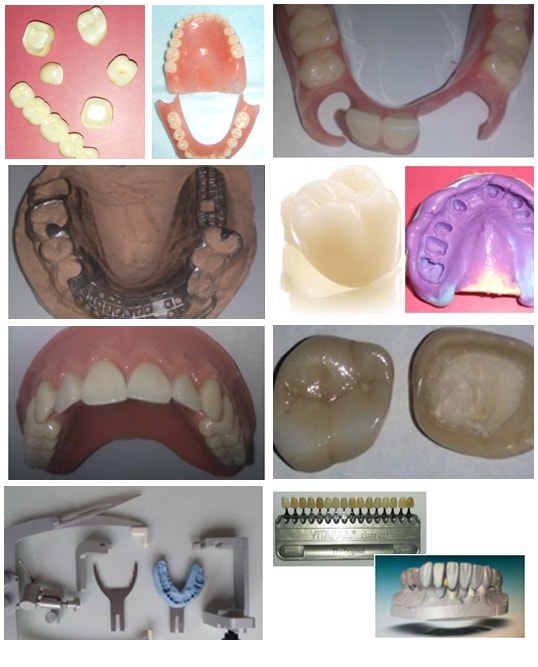prosthodontist caps crowns and bridges treatments in pune