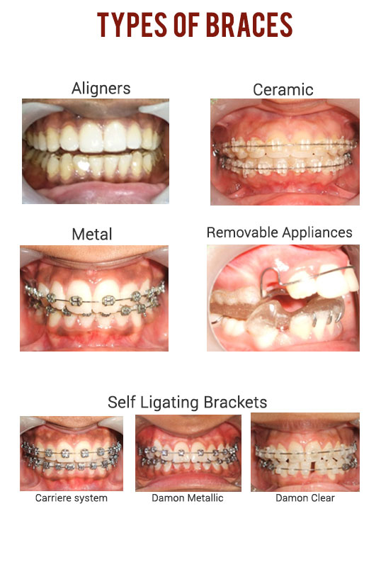 orthodontist braces specialist in pune
